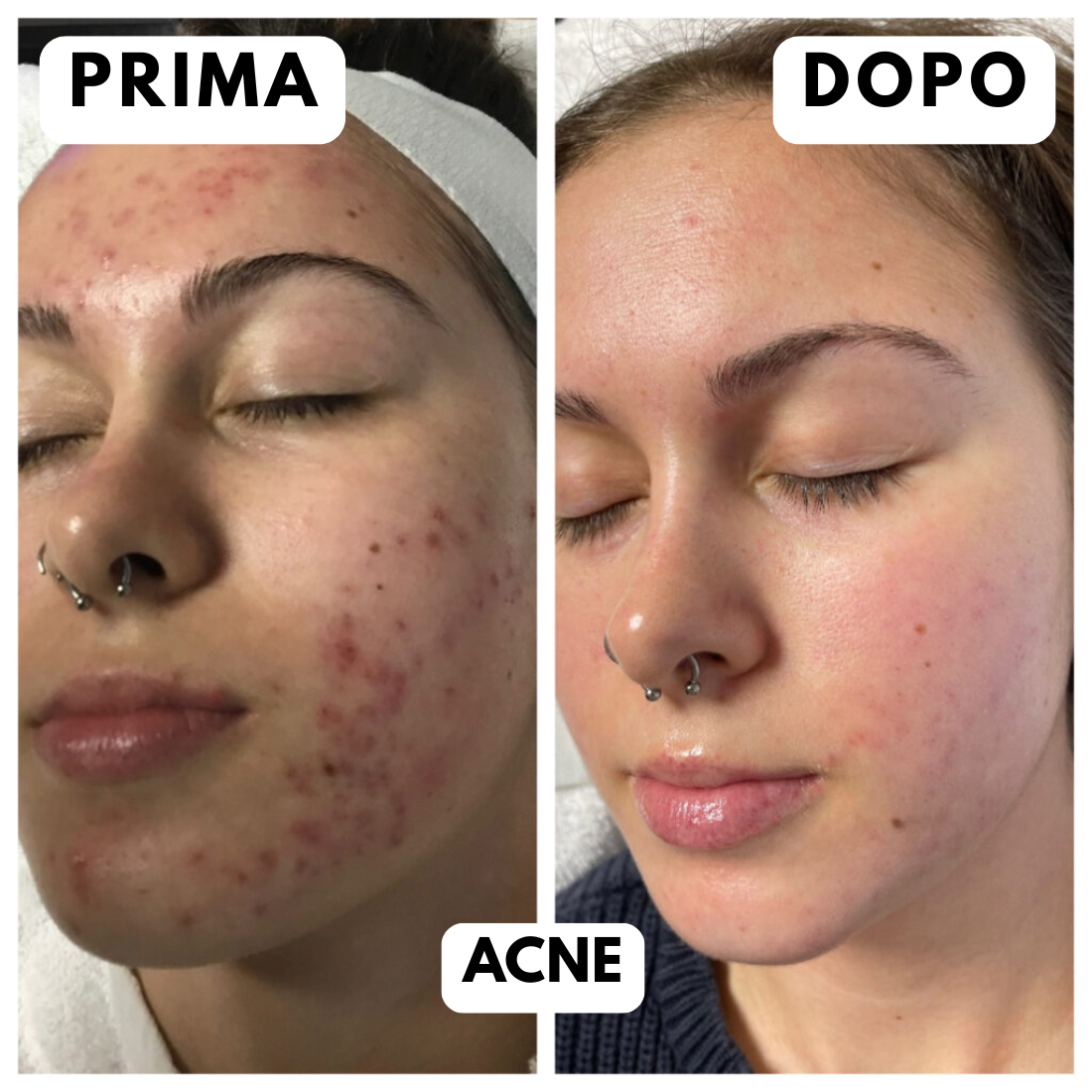 Offerta Black Friday-Maschera LED Viso Anti-Età